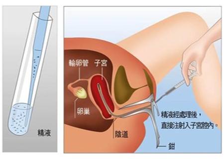 人工授精