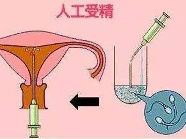 人工授精