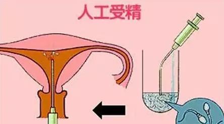 人工授精